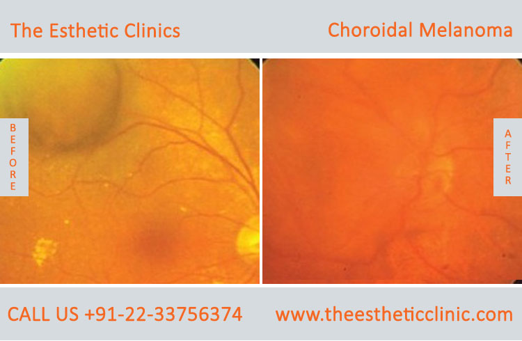 Choroidal Melanoma Eye Cancer Treatment before after photos in mumbai india (1)